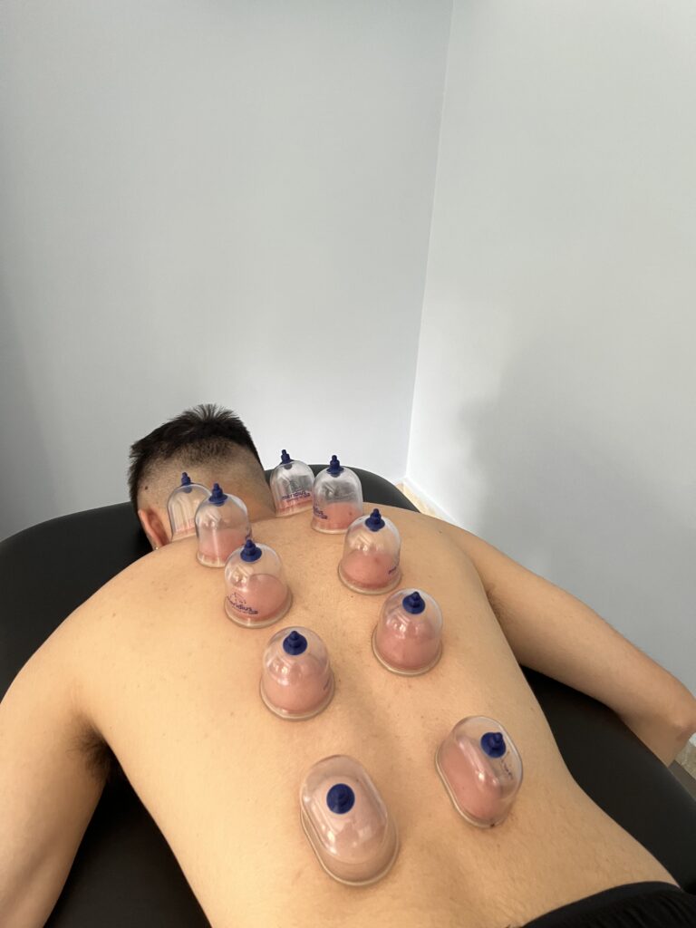 Cupping Therapy 1