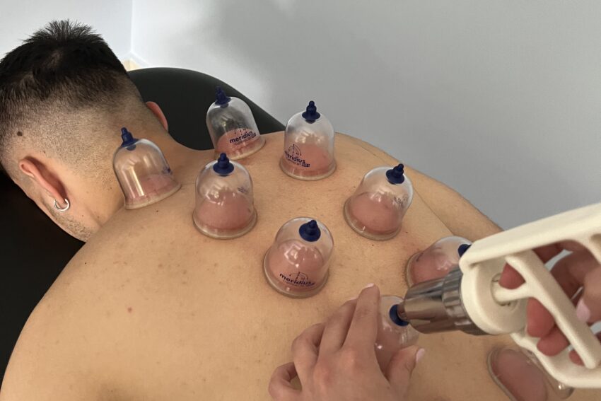 Cupping Therapy